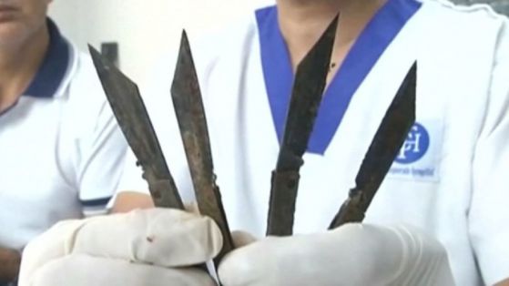 Лекари извадиха 40 джобни ножчета от стомаха на 42-годишен мъж